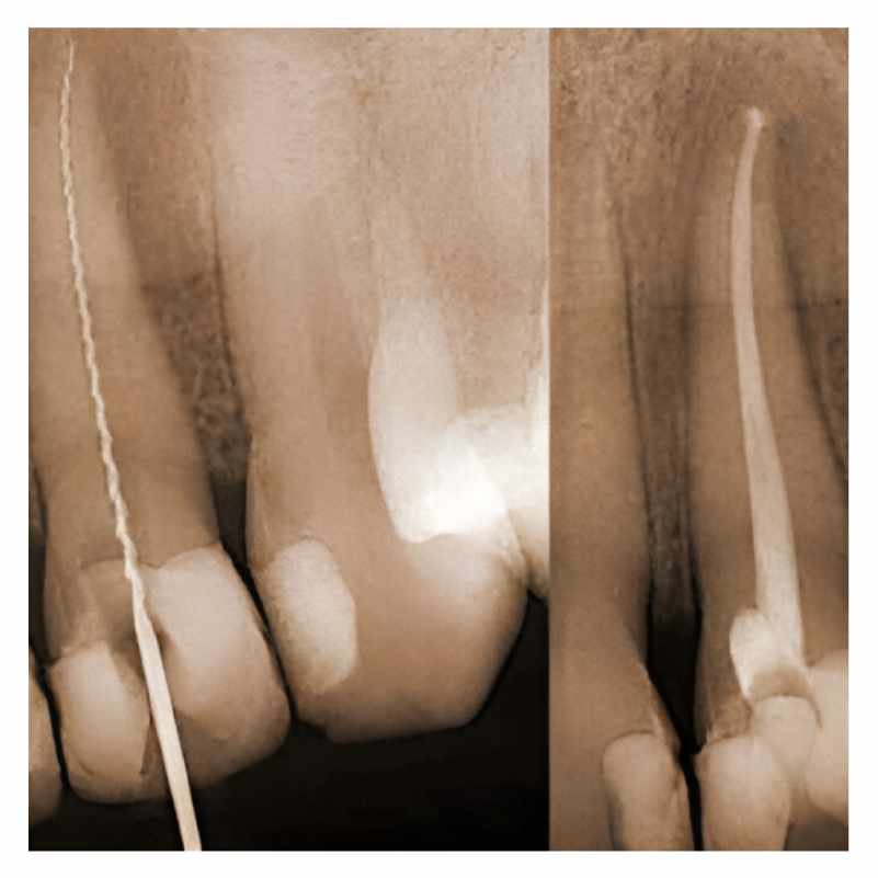 Image for Service: Root Canals
